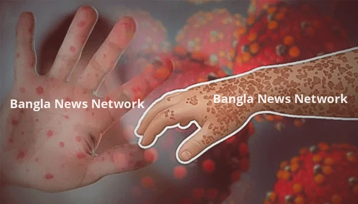 ২৪ ঘণ্টায় হামের উপসর্গে প্রাণহানি ৩, আক্রান্ত ৮৭২
